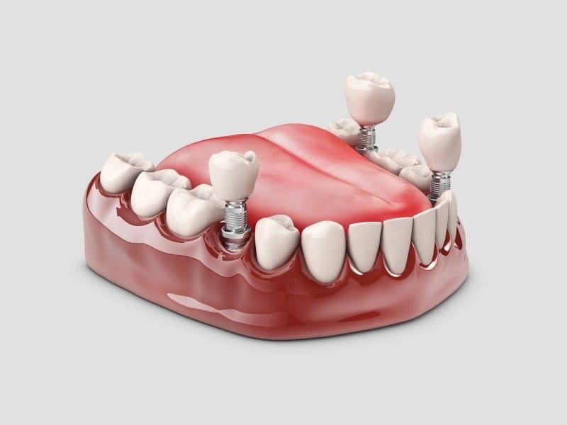 MegaGen Implants: AnyRidge, Xpeed and Where They Are Made