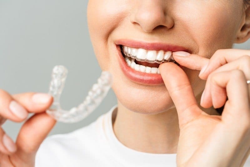Invisalign Treatment