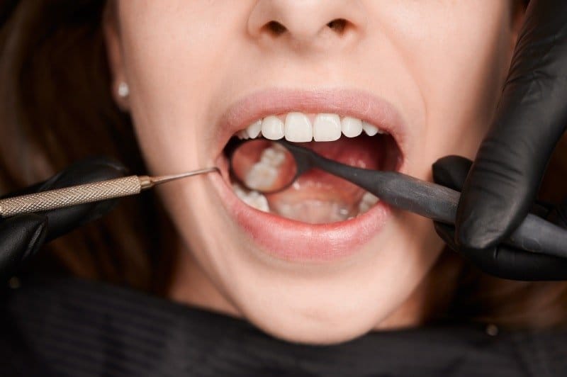 Wisdom Tooth Extraction