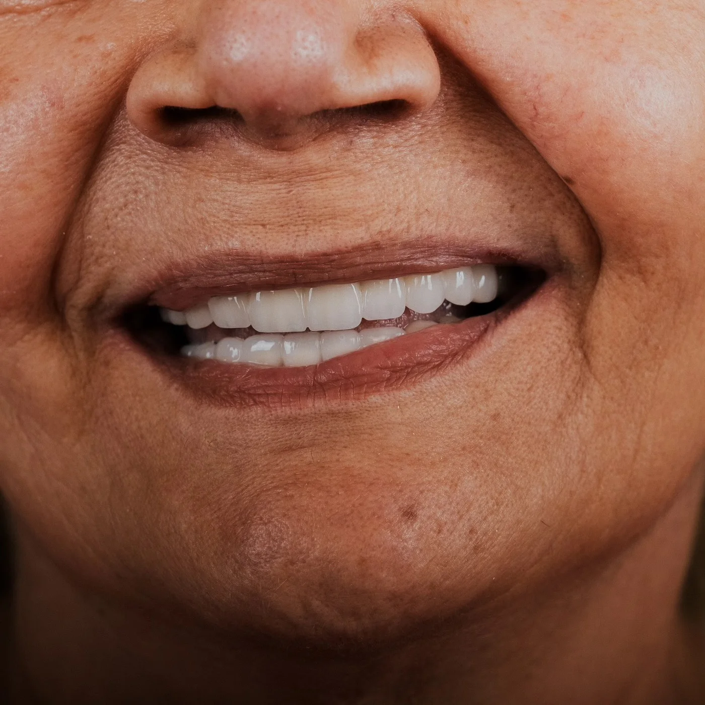 Natural-looking smile after zirconia crowns, close up
