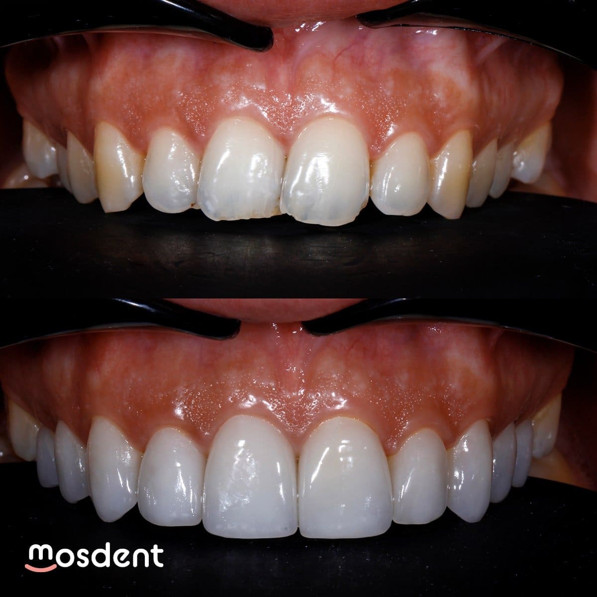 mosdent3 (1) min