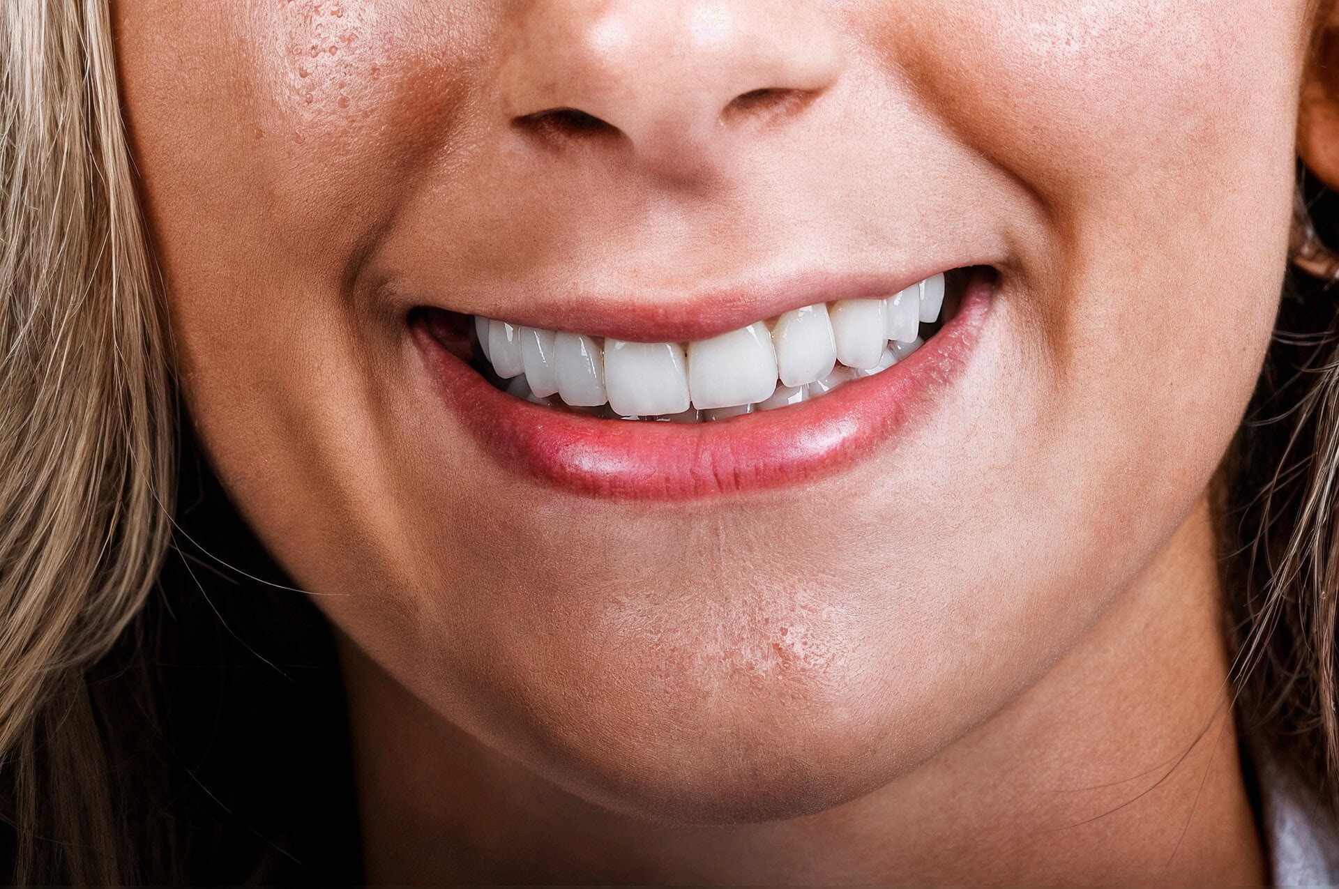 smile makeover i