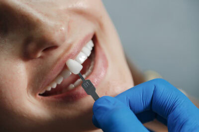 porcelain veneers