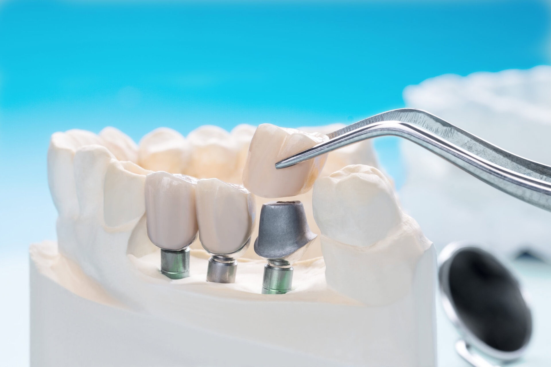 close up implant and prosthodontic model.