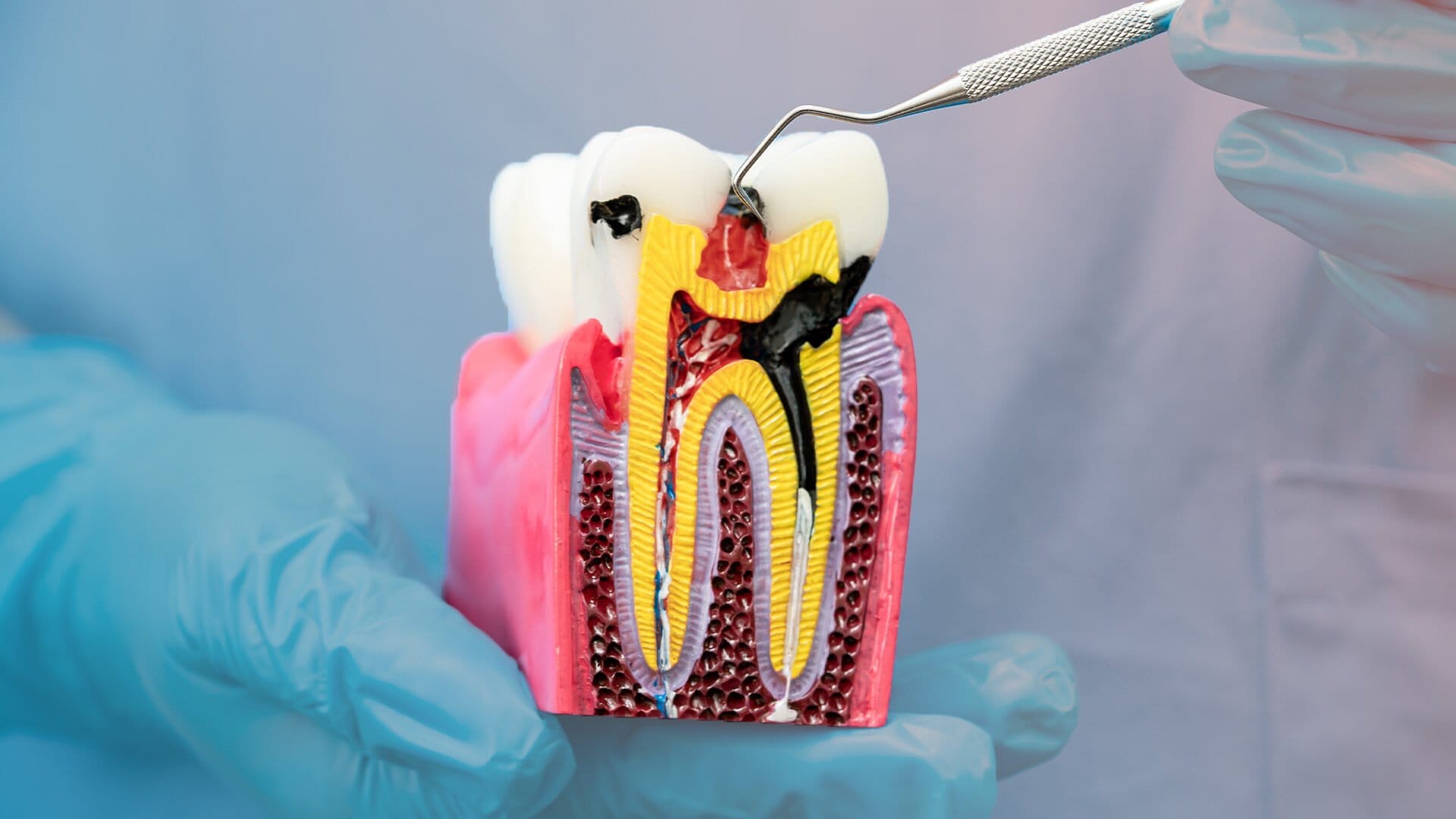 Unsuccessful Root Canal Treatment