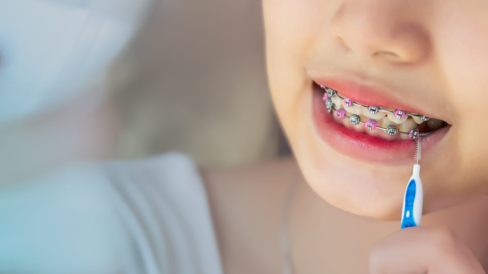 Oral Care Methods for Those with Braces