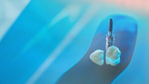 akıllı implant nedir blog