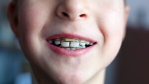 Retainers: Their Role in Permanent Success of Orthodontic Treatment