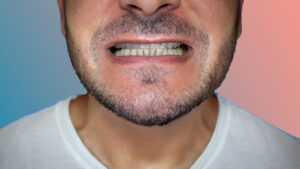 Crooked Teeth: Why Do They Happen and How to Fix Them?