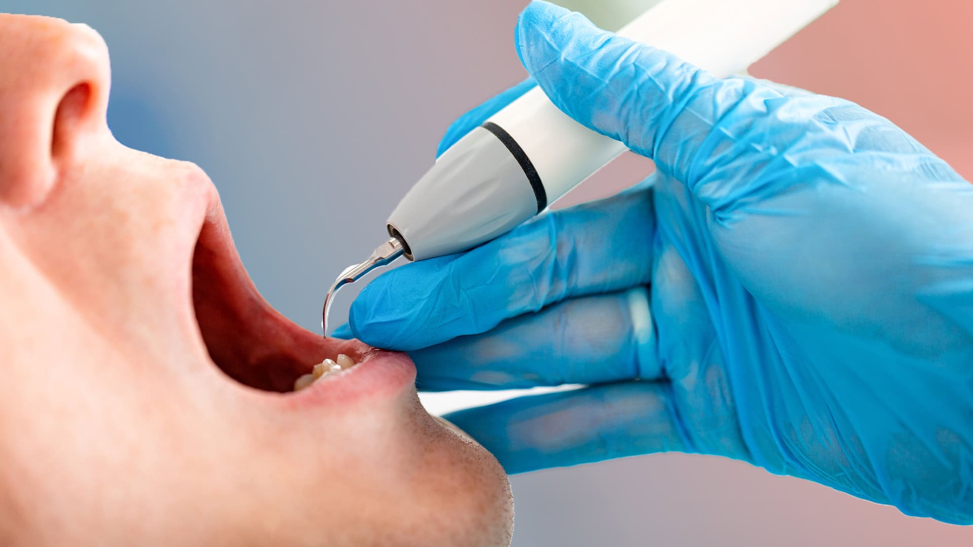 Everything You Need to Know About Rotten Teeth: Symptoms, Causes and Effective Treatment Methods