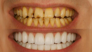 Full Mouth Reconstruction: Costs, Procedures, and What to Expect