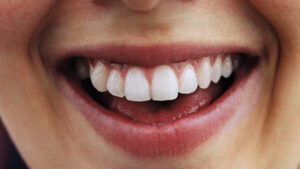Gummy Smile: Causes, Treatments, and Celebrity Transformations