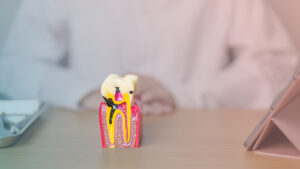 From Spots to Cavities: Understanding, Healing, and Preventing Tooth Decay Naturally and Professionally
