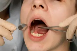 Comprehensive Guide to Frenectomy: Procedure, Types, Cost, and FAQs