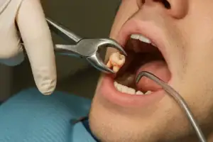 Extracted Wisdom Tooth Healing: A Complete Guide to Recovery