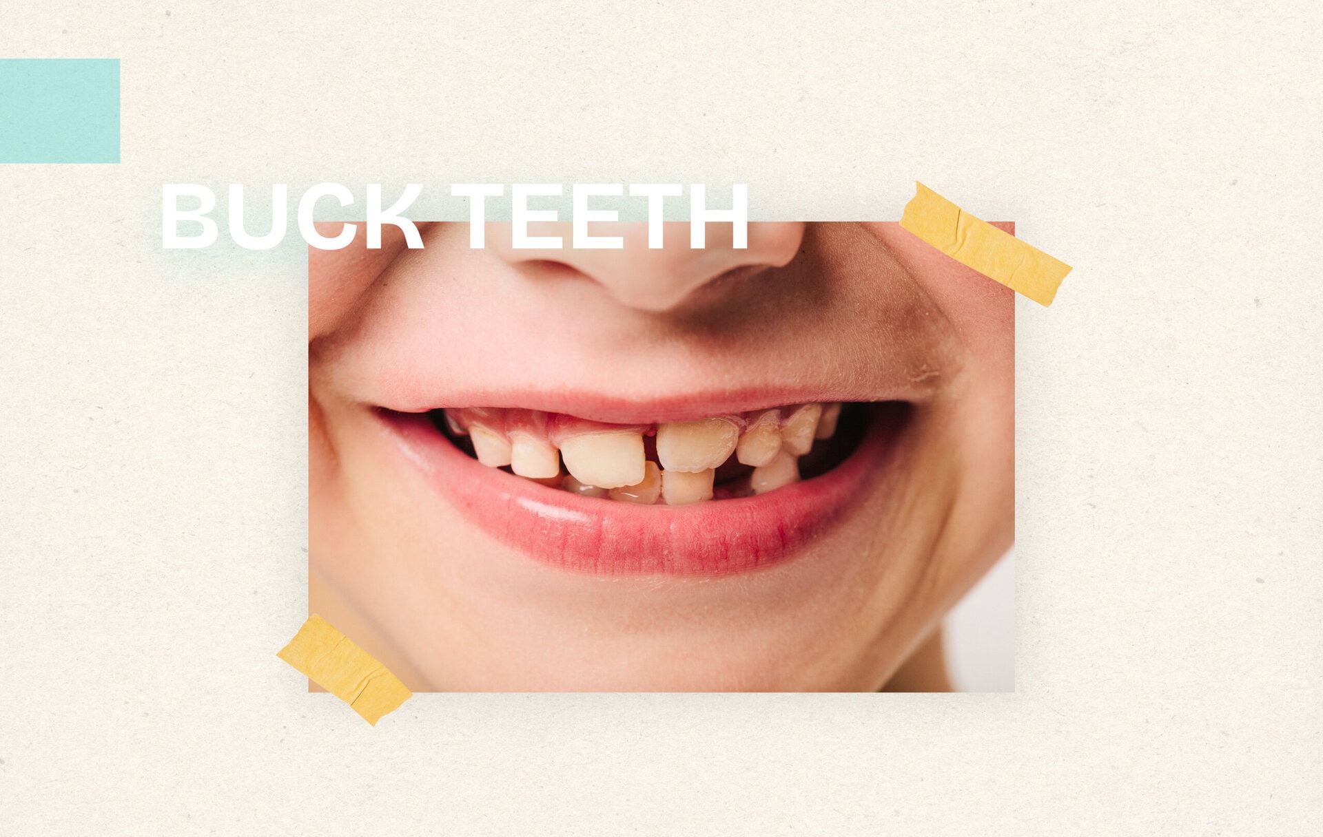 Buck Teeth