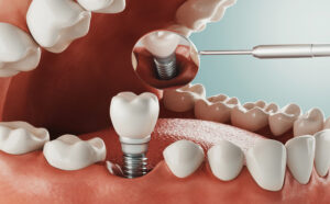 Molar Tooth Implant: Everything You Need to Know for a Lasting Smile
