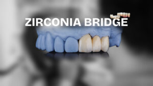 Zirconia Bridge