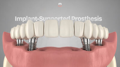 Implant-Supported Prosthesis 