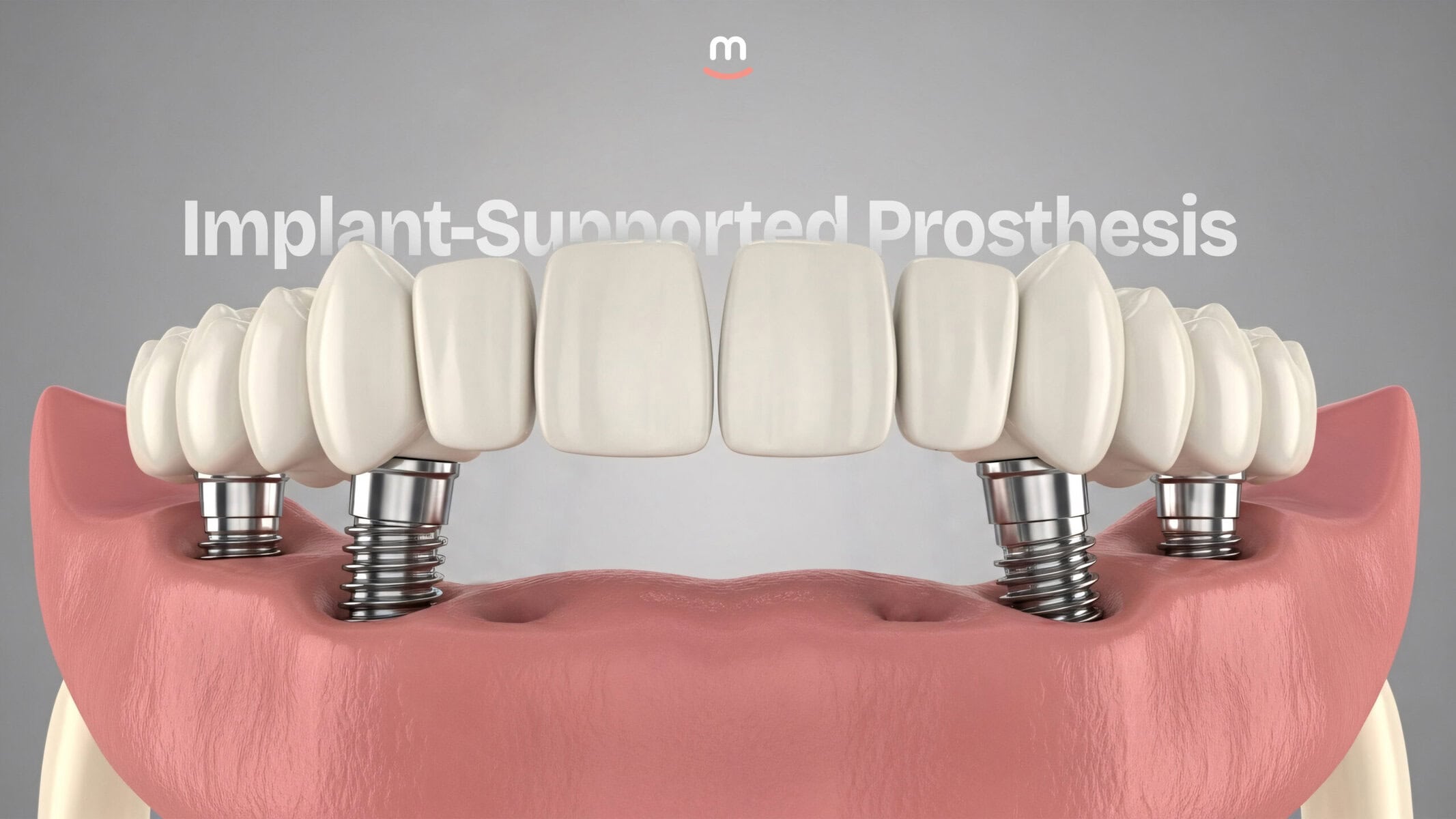 Implant-Supported Prosthesis