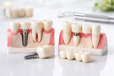 Dental Implant vs Dental Bridge