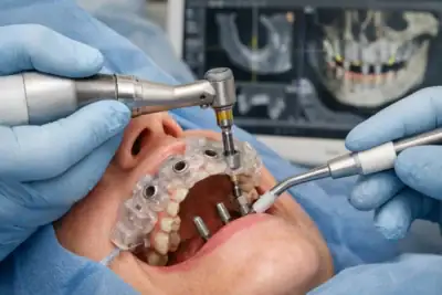 What Is Guided Implant Surgery?